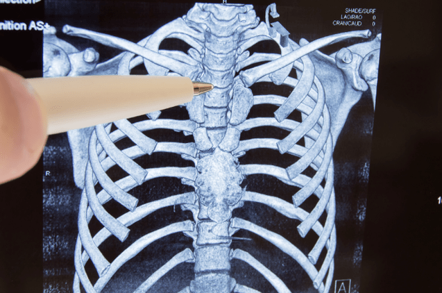 Osteochonroz